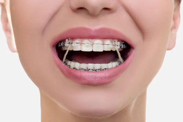 Accessoires Orthodontiques 2